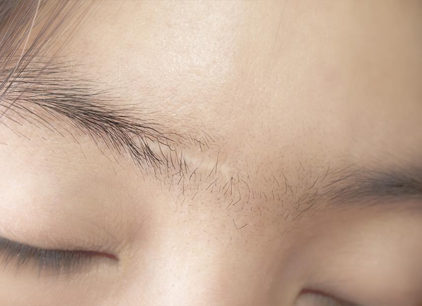 Do eyebrows grow back on scars?
